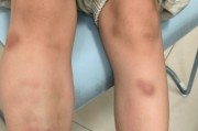 九游体育官网-深圳6岁男童吃生菜包烤肉后，全身出现大片青斑、血肿